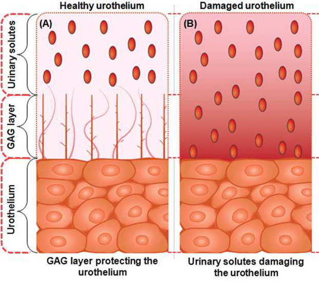 Bladder wall comparison of healthy vs damaged urothelium and GAG layer